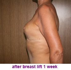 plastic-surgery-breast-lift